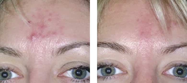 Acne-Before-After-2
