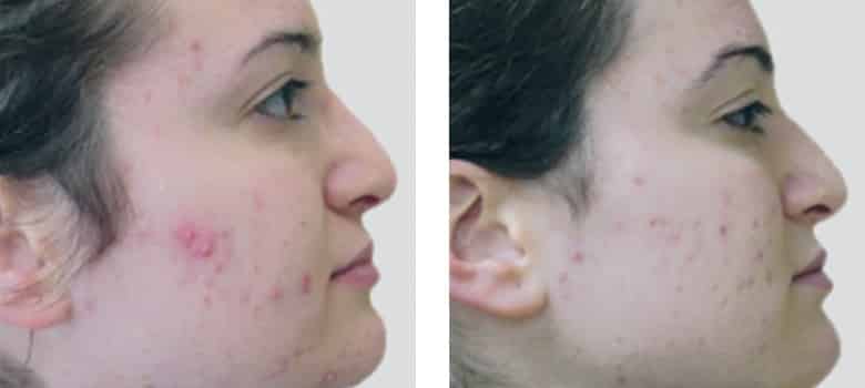 Acne-Before-After-3