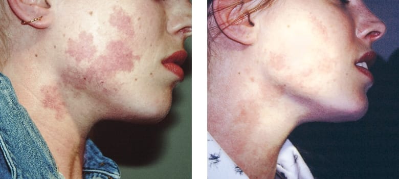 Birthmarks-Before-After-1-1