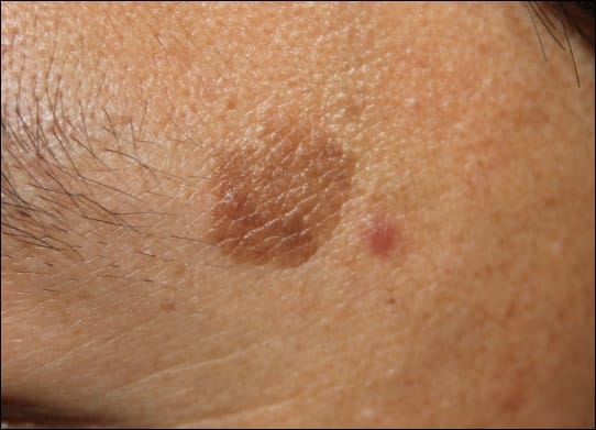 Brown-Spots-About-The-Condition