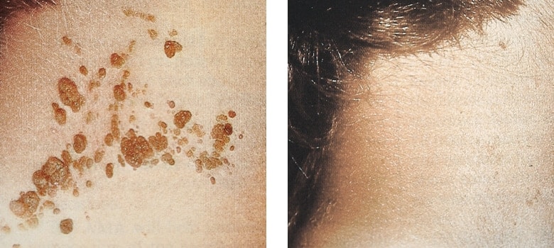 Brown-Spots-Before-After-2