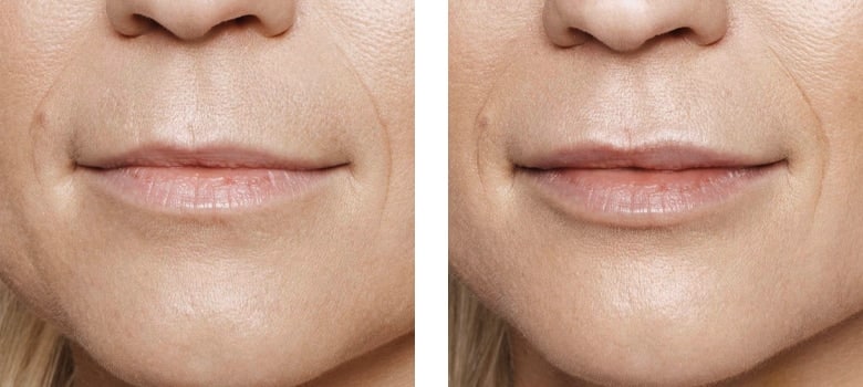 Lip-Augmentation-Before-After-1