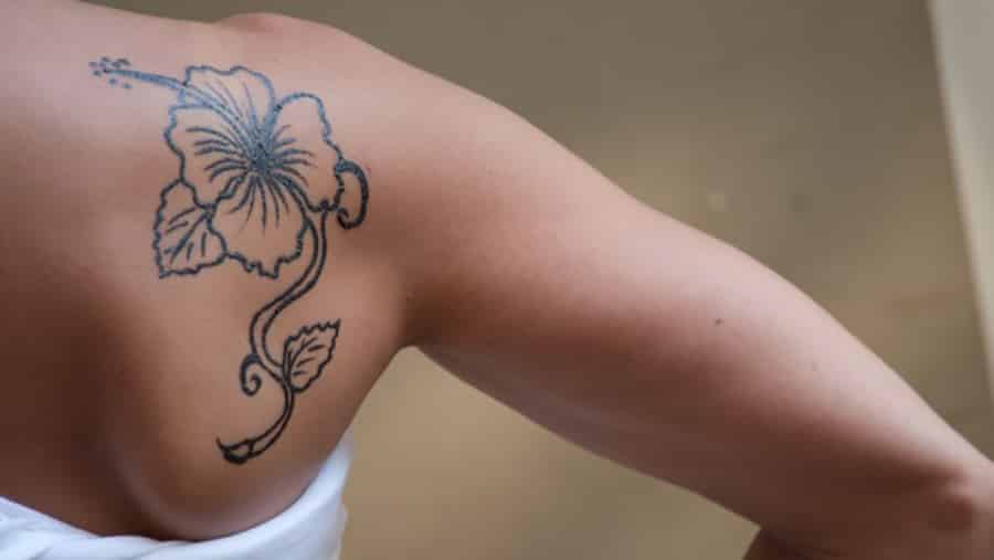 6 Things you need to know about removal of tattoos