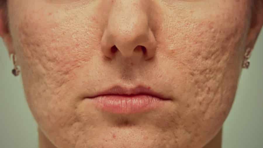 Acne Scarring – Facts and Statistics