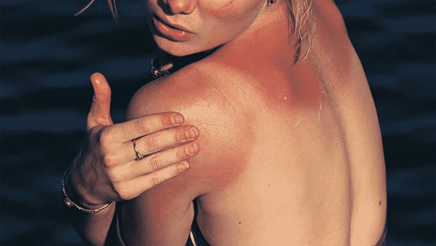 All You Need To Know: Sun-Damaged Skin