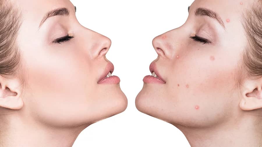 Laser Acne Therapy – Facts
