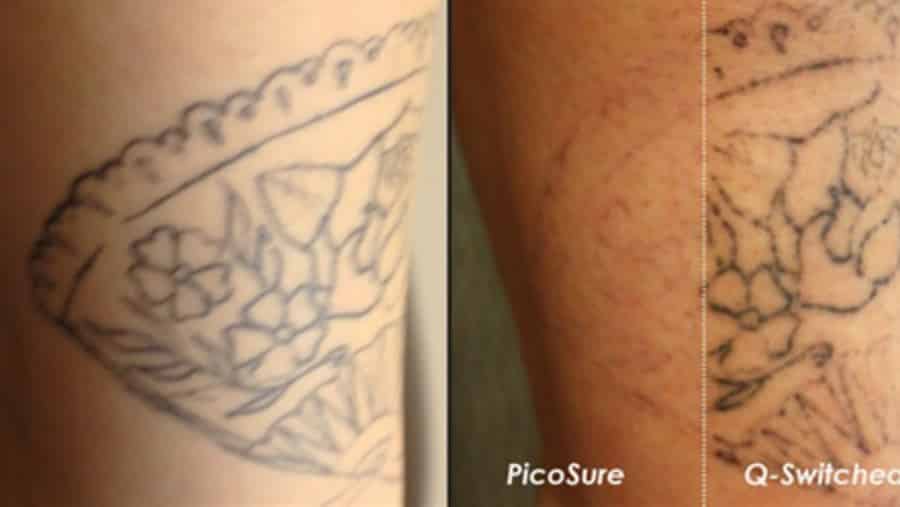 How Effective is Laser Tattoo Removal?
