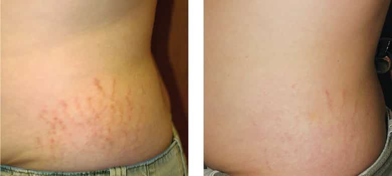 Stretchmarks-Before-After-1