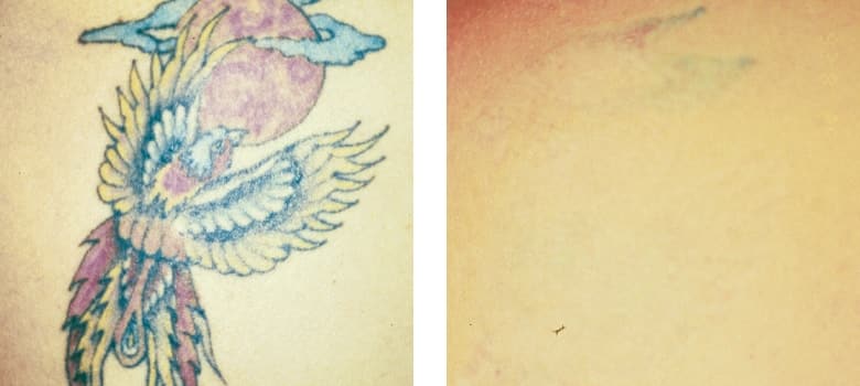 Tattoo-Removal-Before-After-2