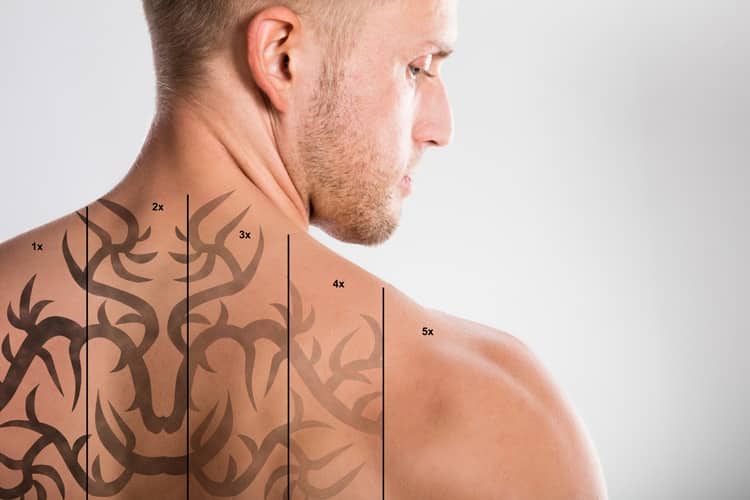 Laser Tattoo Removal - Does laser tattoo removal hurt? - YouTube