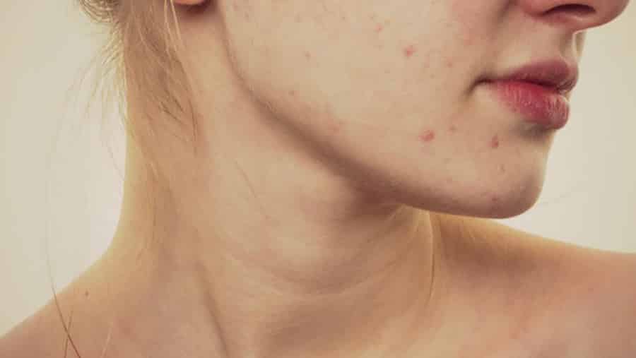Treatments for acne scarring