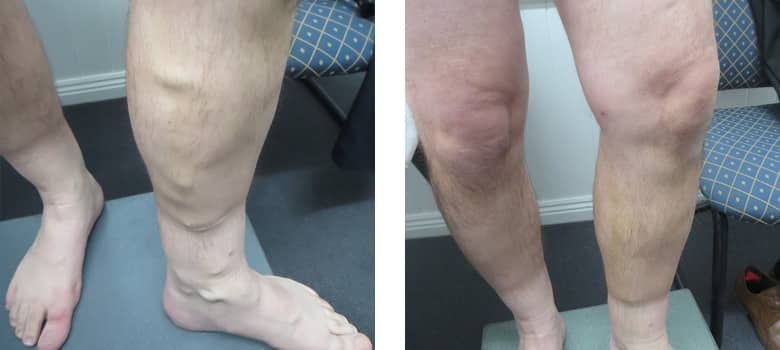 Varicose-Veins-Before-After-3