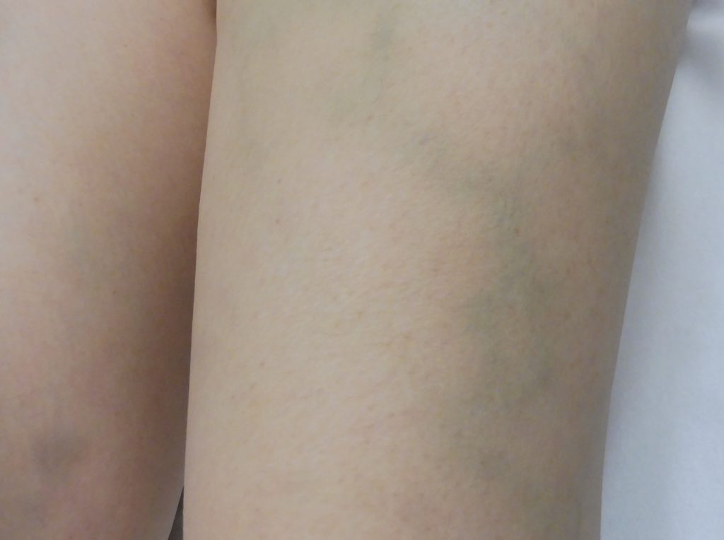 Branch Varicose Vein: Treat Surface Sclerotherapy (with Foam)