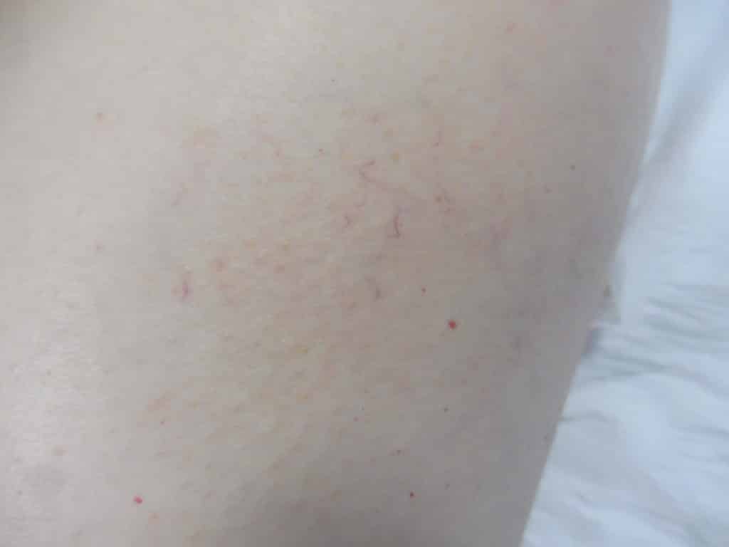 Isolated Spider Veins: Treated by Laser or Veingogh