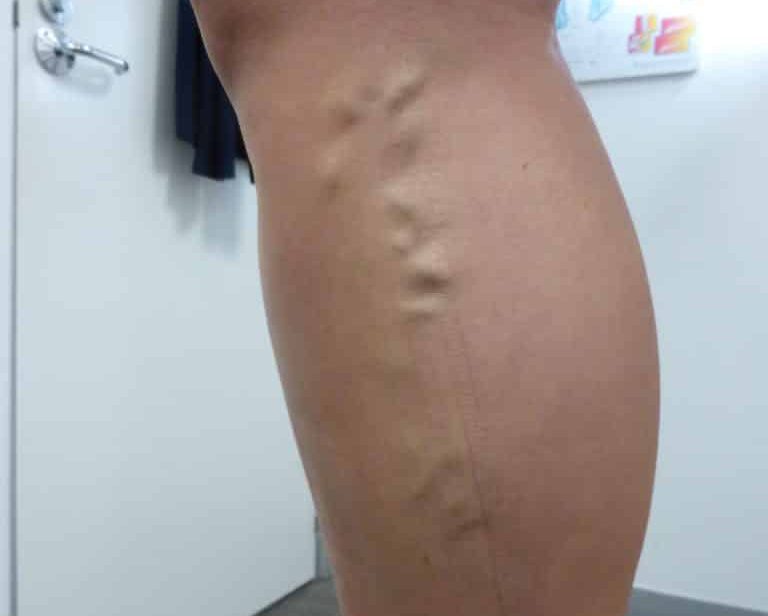 Truncal Varicose Vein: Treat Ultrasound Guided Radiofrequency