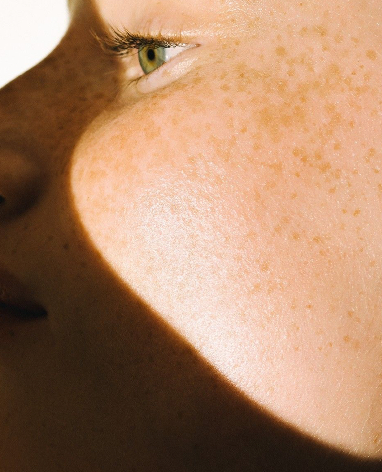 Facial pigmentation and sunspots before treatment